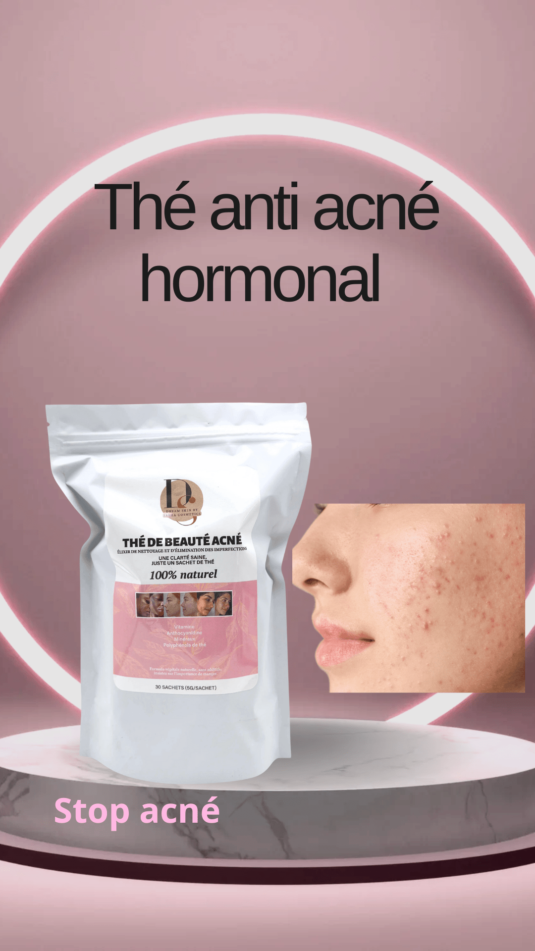 THÉ ANTI ACNÉ HORMONAL - DREAM SKIN by Sasha Cosmetics